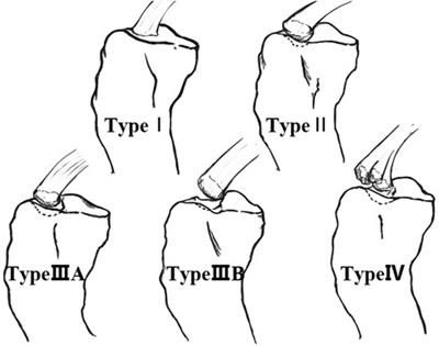 Arthroscopic fixation techniques for tibial eminence fractures in pediatric patients: a review